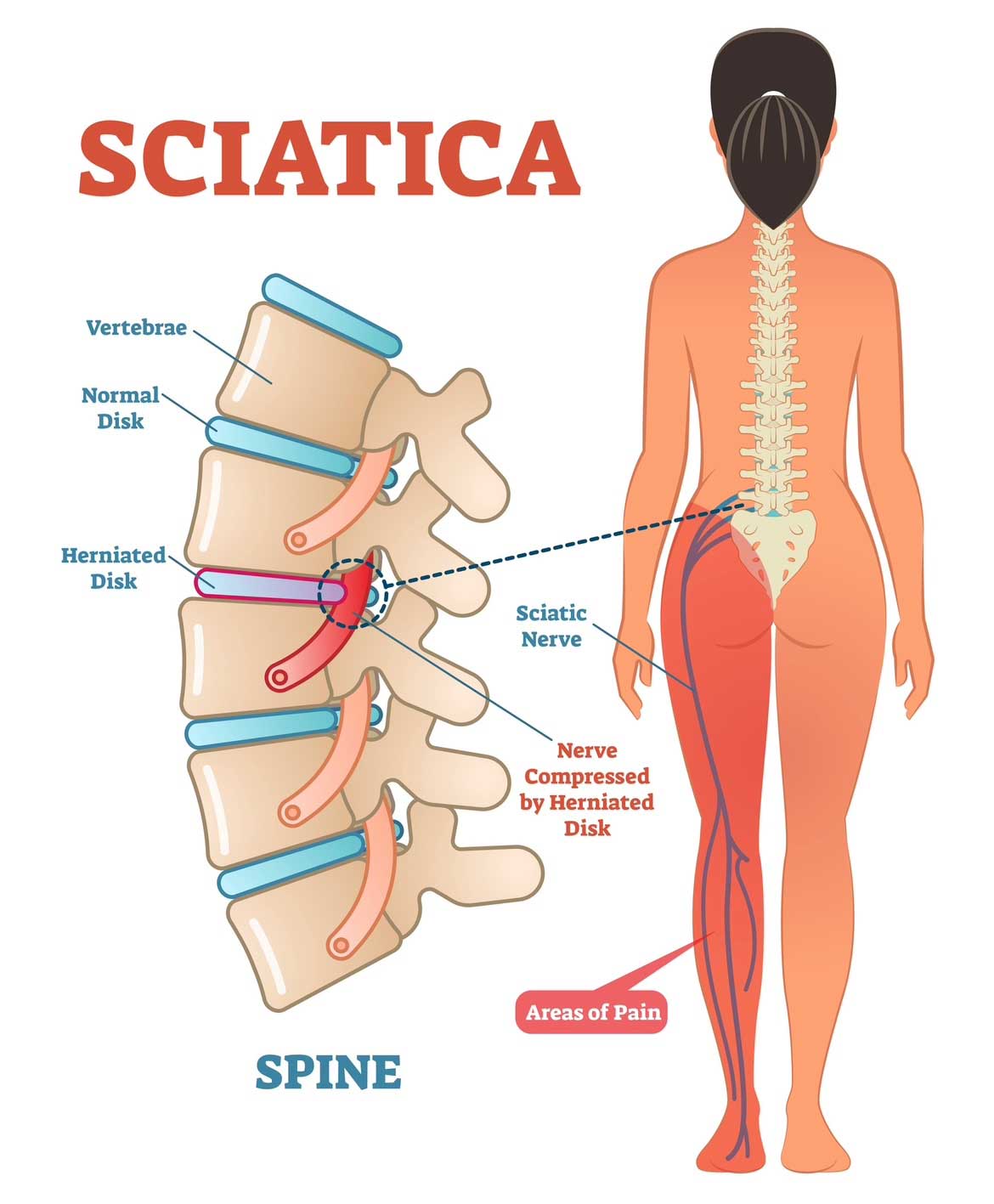 Image of Sciatica